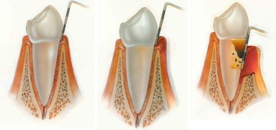 Fases Periodoncia