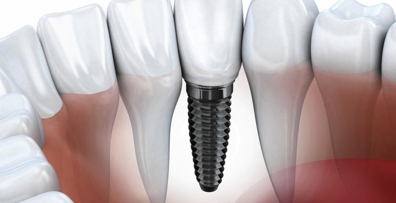 Implantes dentales