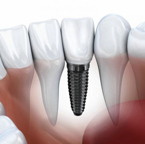 Implantes dentales